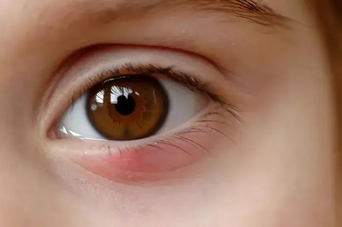 Причины появления ячменя у детей фото